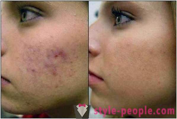 Azelainsyre skreller: anmeldelser kosmetologer, bilder før og etter