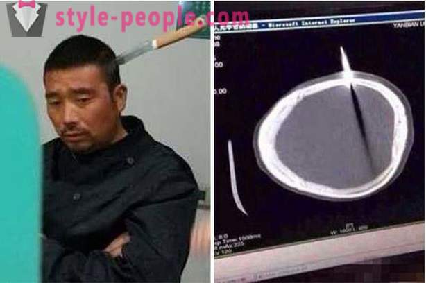 En kinesisk mann med kniv i hodet gikk han til legen