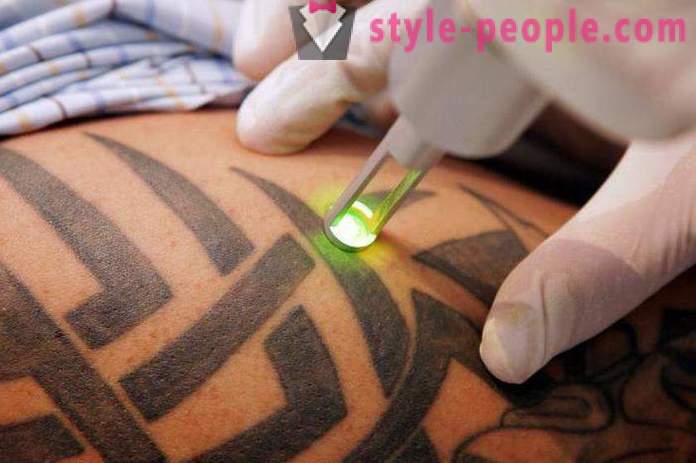 Laser tatovering fjerning. Anmeldt av