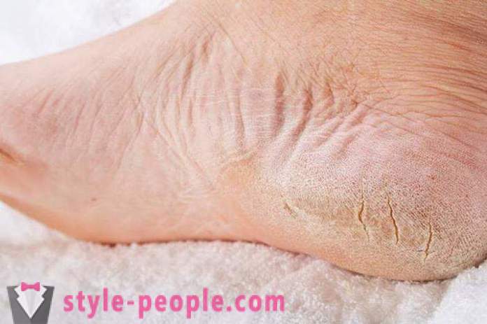 Tørr hud på føttene: Årsaker