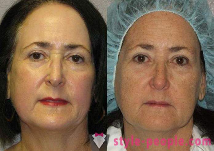 Laser resurfacing av ansiktet - en sikker måte å forynge